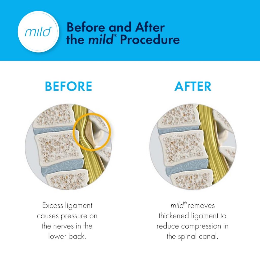 Learn More About the mild® Procedure Available at South Central Pain